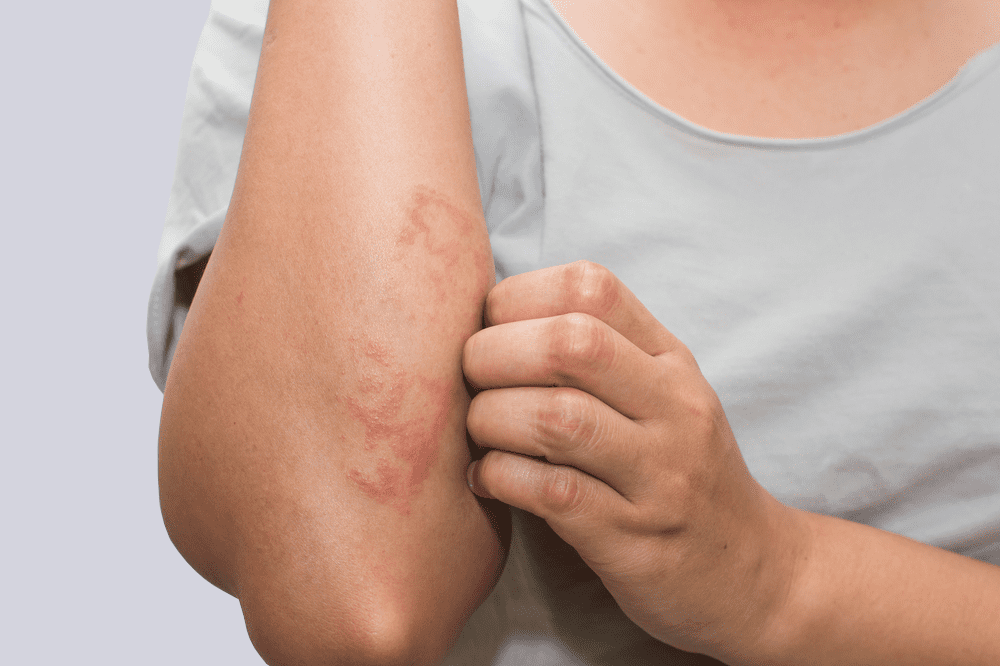 A person with red spots on their arm.