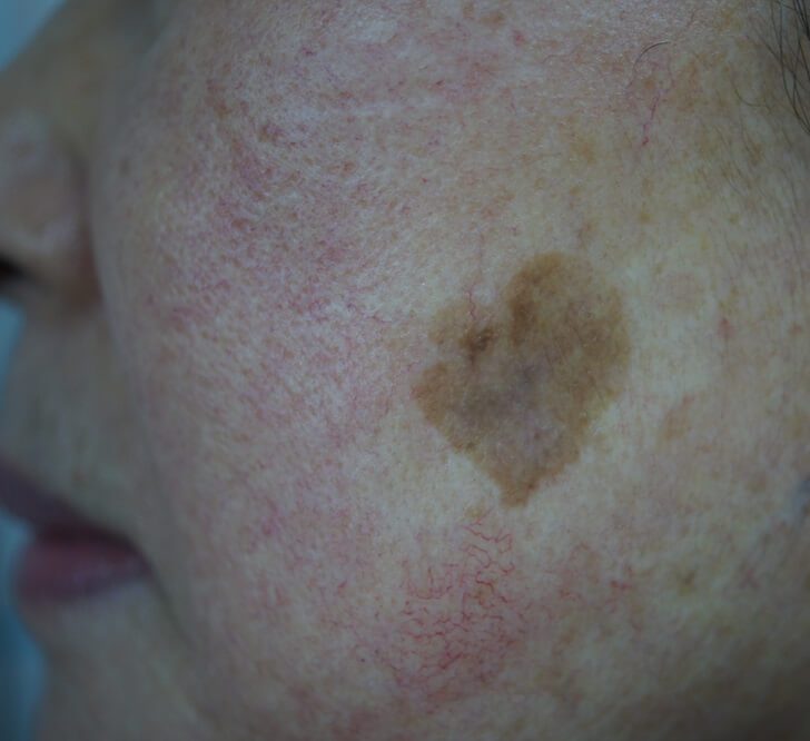 A close up of the skin with brown spots