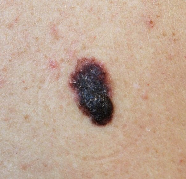 A close up of the skin with melanoma