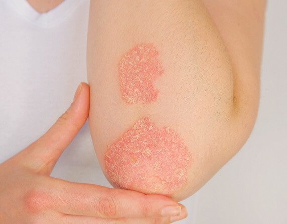 A person with psoriasis on their arm.