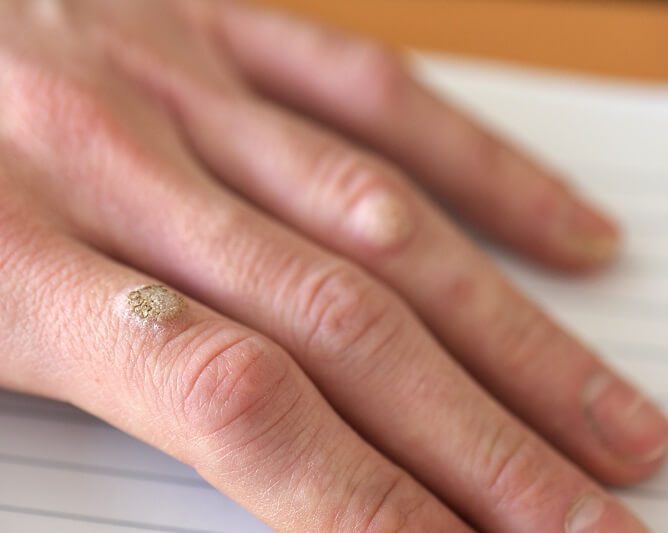 A person with warts on their hands.
