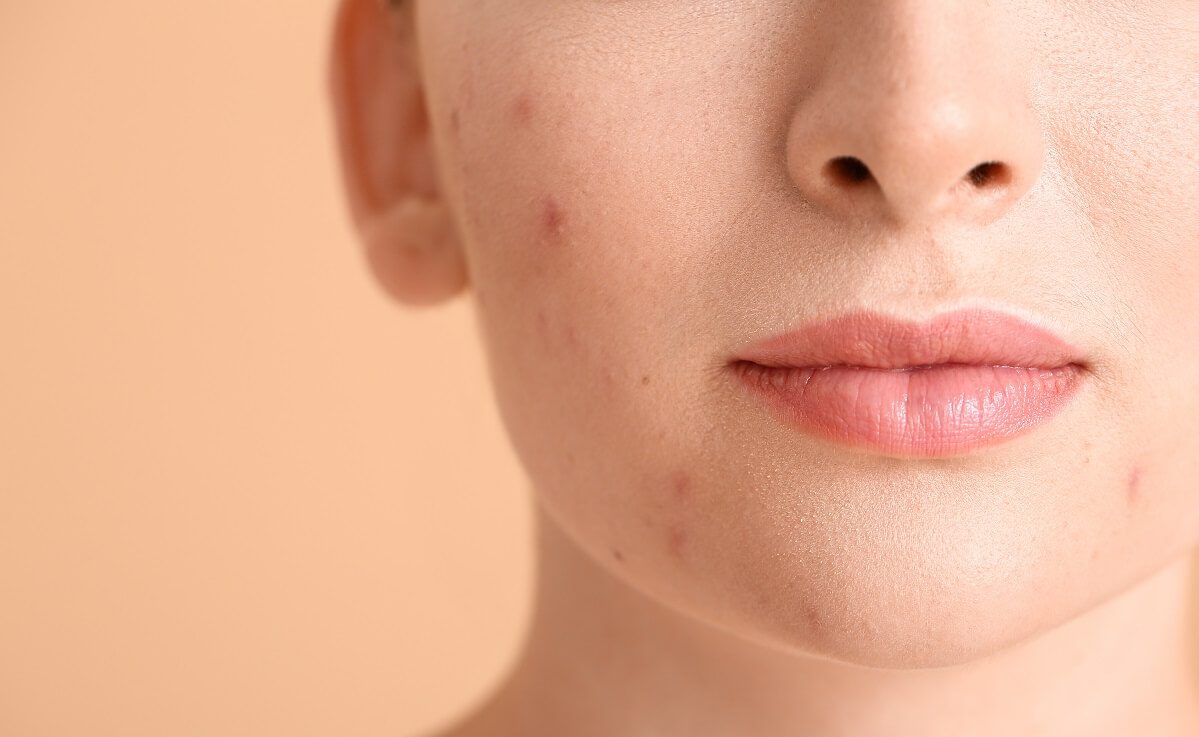 A close up of a person with acne on their face
