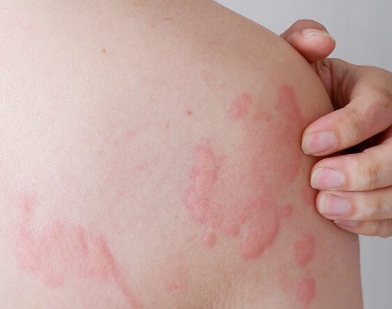 A person with red bumps on their back