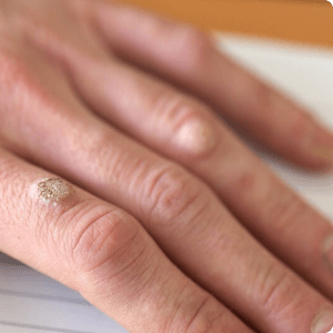 Close-up of a hand with a bump.