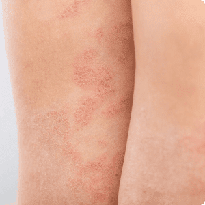 Skin with red patches and irritation.