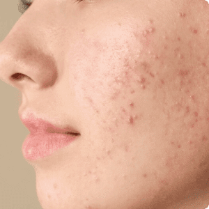 Close-up of skin with acne and blemishes.