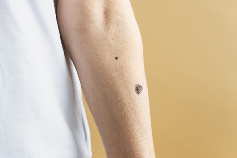 Unusual moles with uneven edges can be a sign of melanoma and should get checked by a specialist.