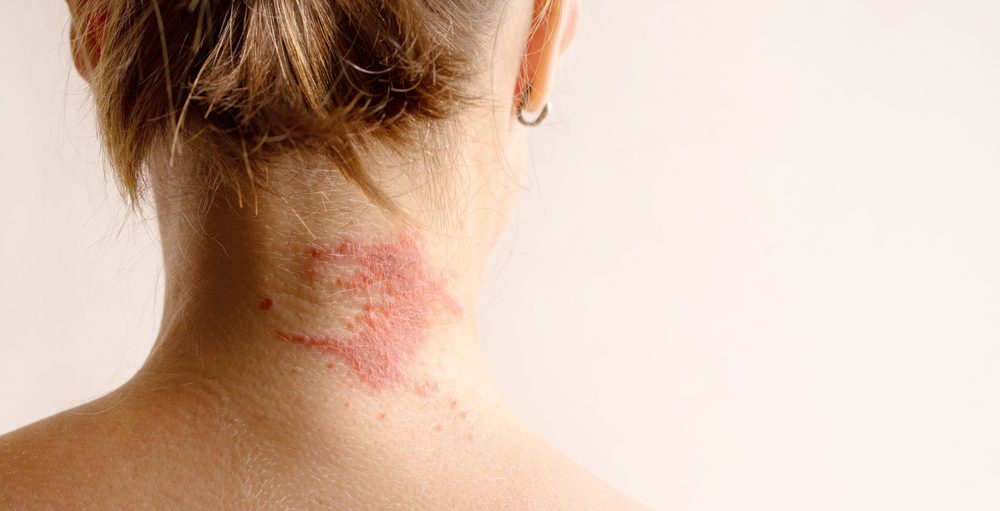 The back of a blonde woman's neck, with eczema on it.