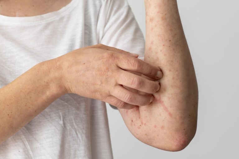 Eczema is one of many types of skin conditions and needs specialised treatment