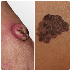 Skin lesions on an arm.