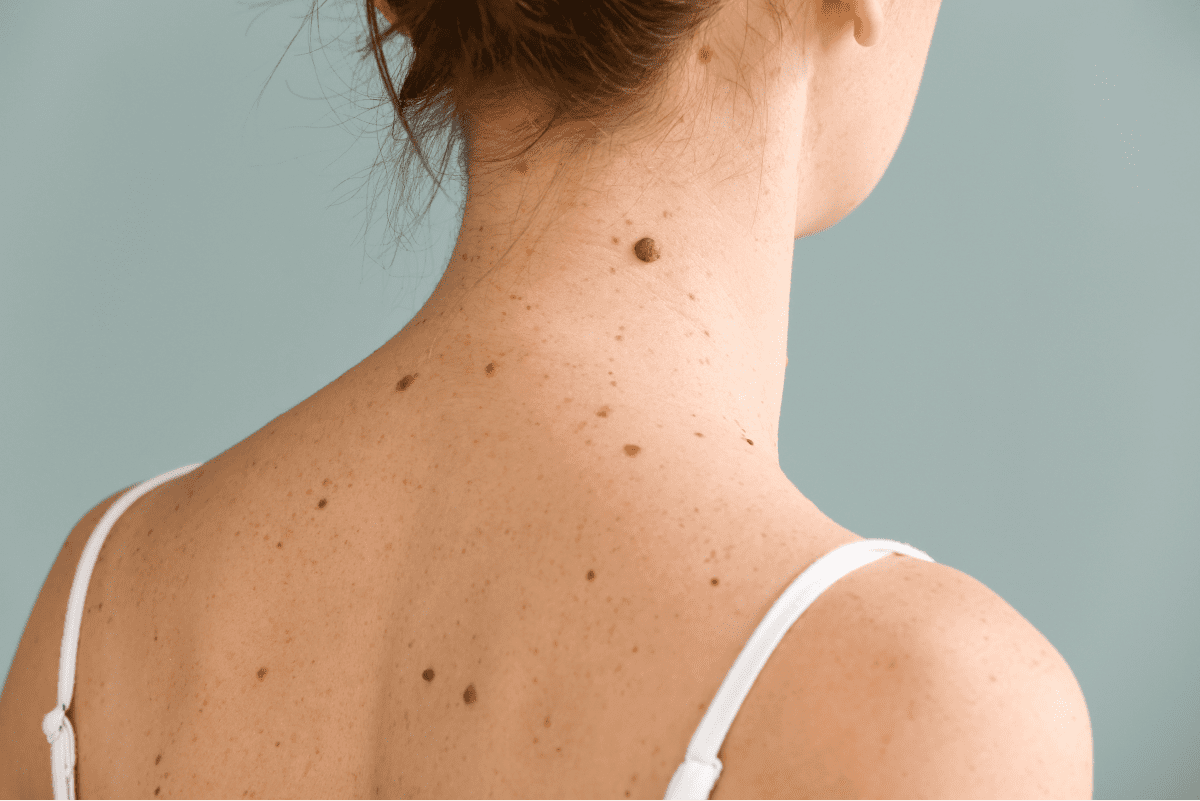 Skin with moles on the back and shoulders.