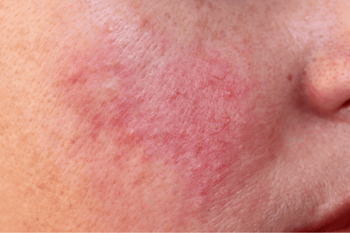Close-up of skin with redness and texture.