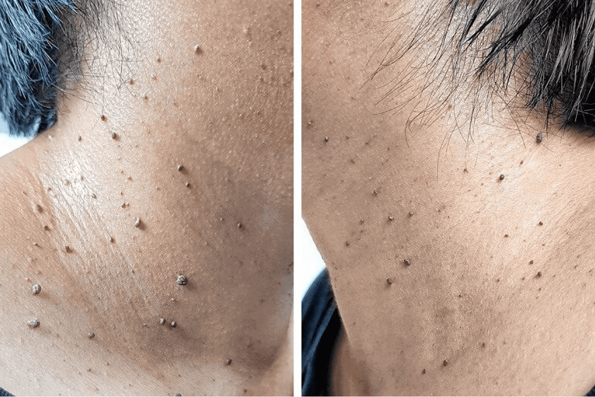 Skin showing numerous small growths.