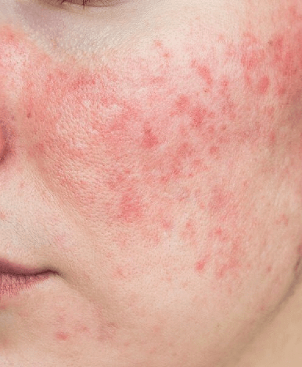 Close-up of irritated, red facial skin.