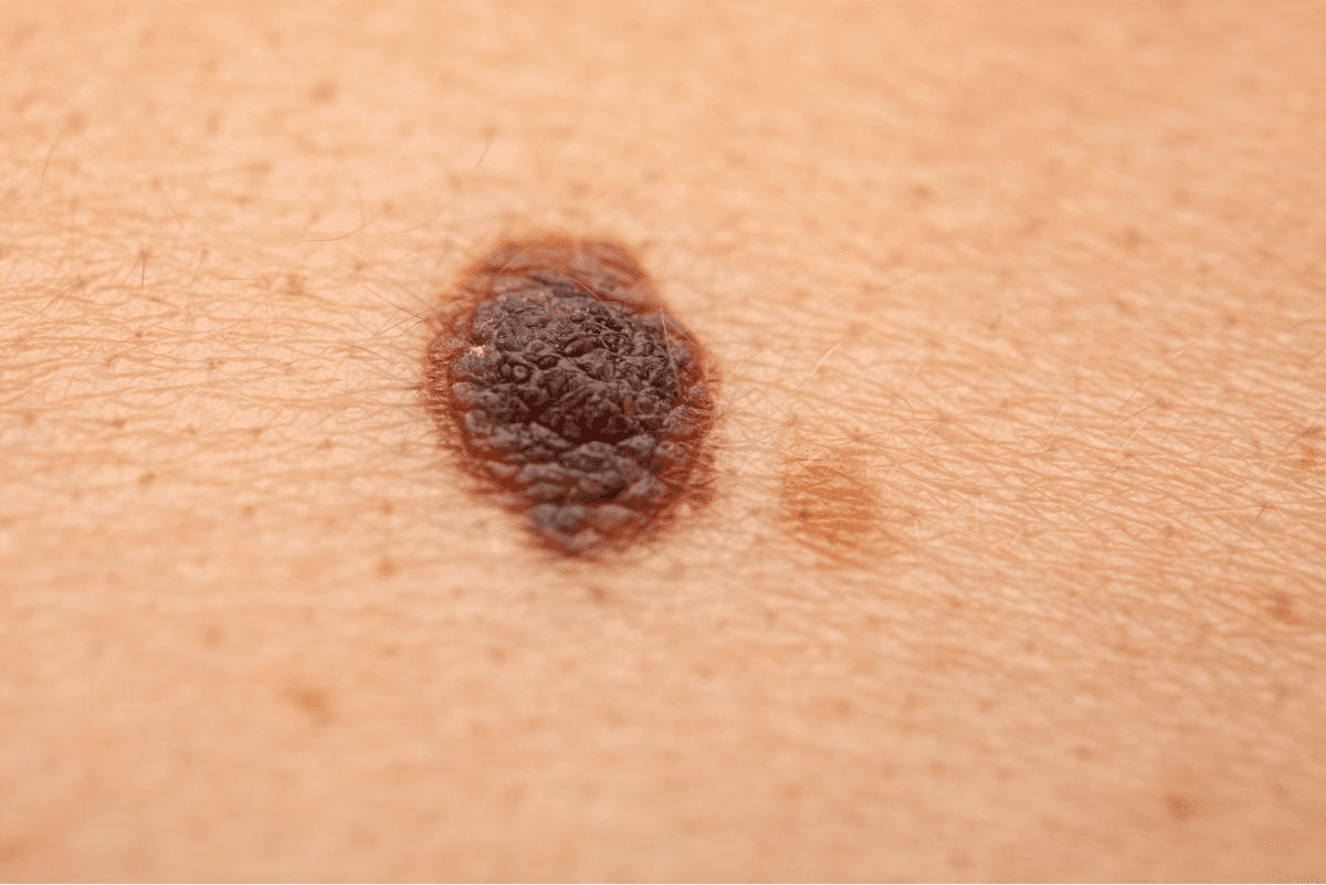 Close-up of a dark skin mole.