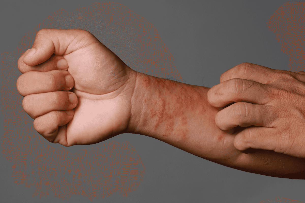 Skin irritation on a person's arm.