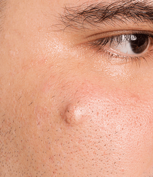 Close-up of facial blemish on cheek.