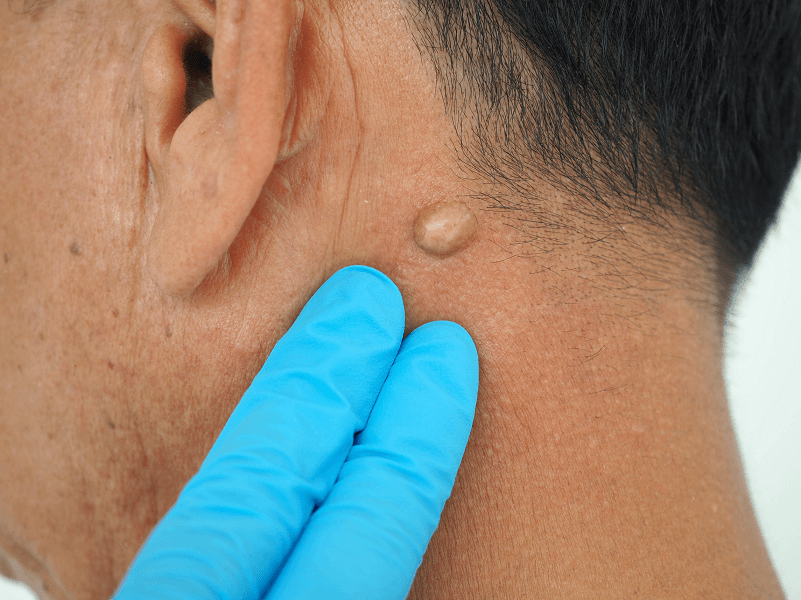 Gloved hand examining mole behind ear.