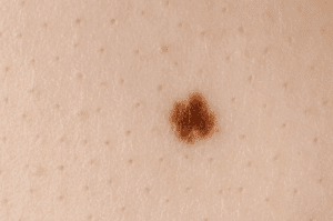 Close-up of a mole on skin.