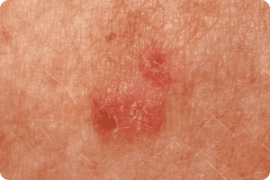 Skin texture with red marks and blemishes.