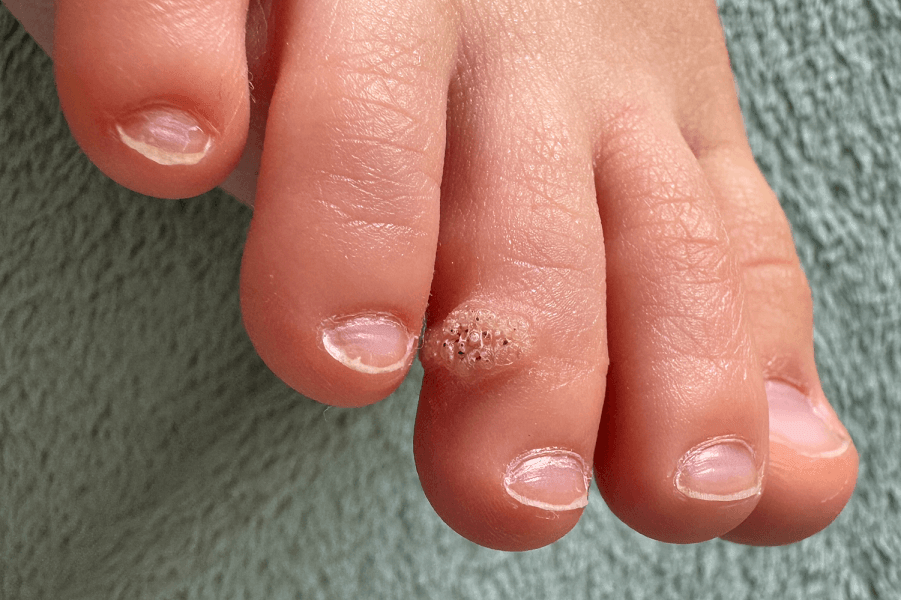 Close-up of foot with wart on toe.