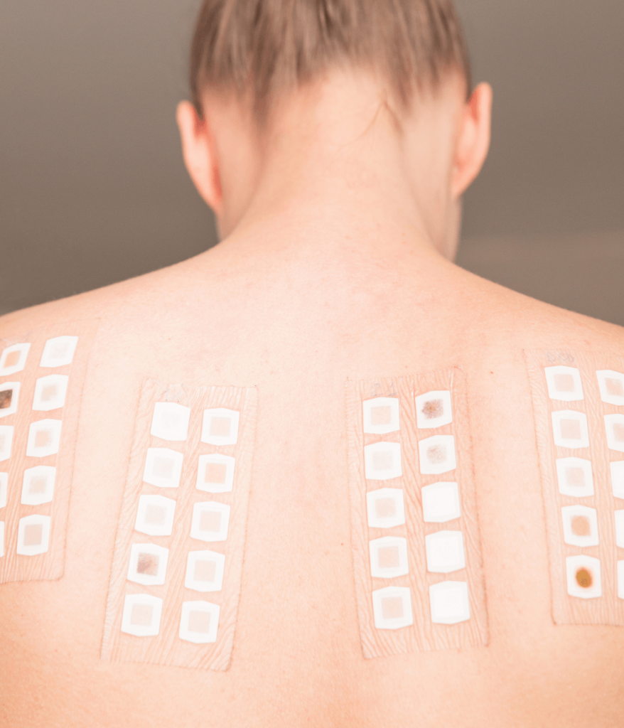 Person's back with allergy test patches applied.