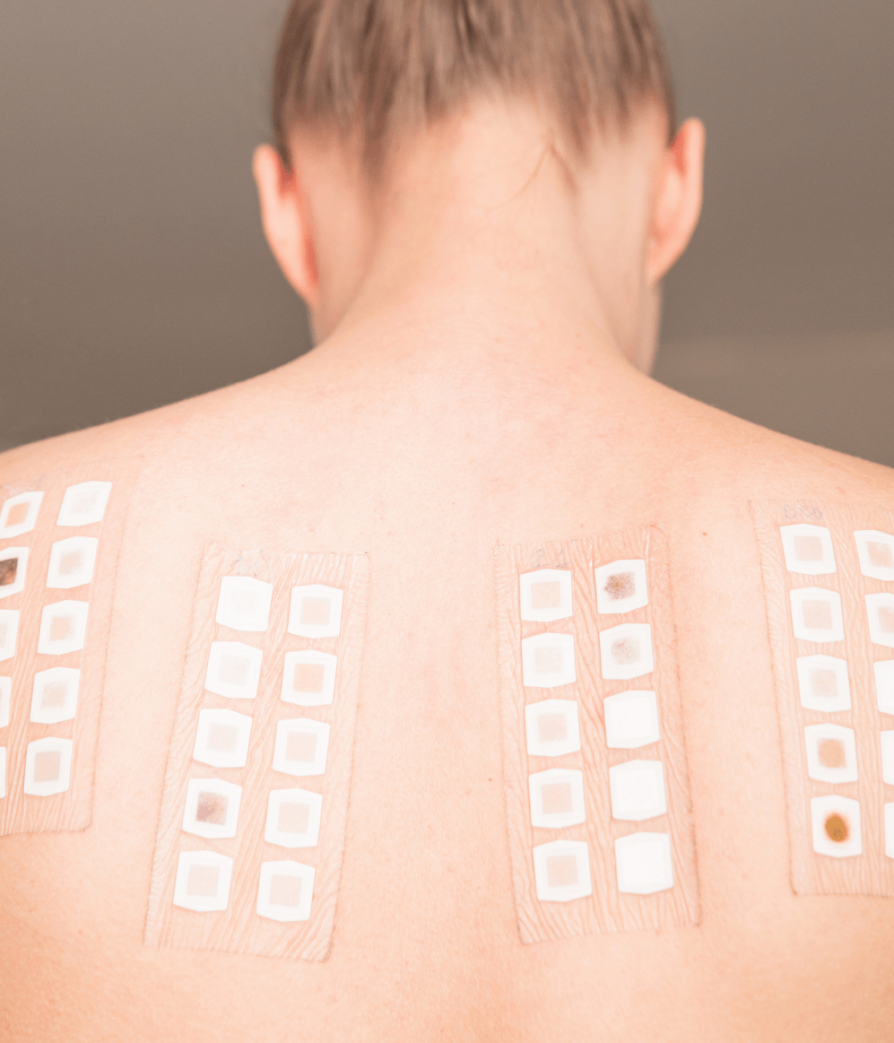 Patch Testing – Dermatology
