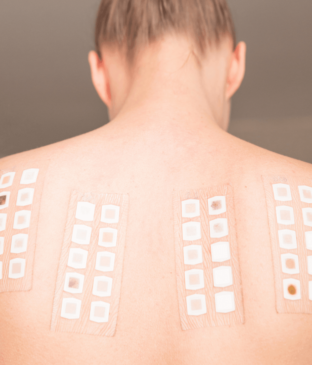 Patch Testing – Dermatology