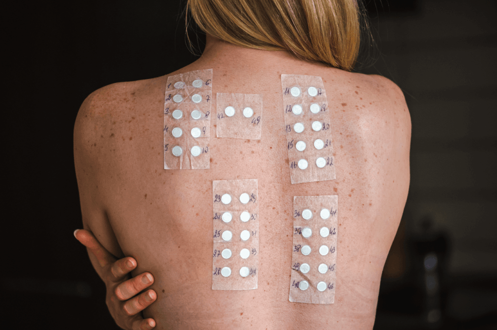 Patches on person's back for allergy testing.