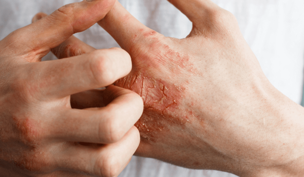 Dry, irritated skin on a hand.