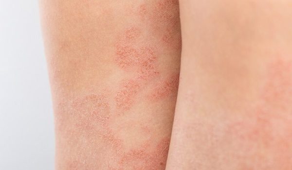 A close up of the skin on someone 's arm